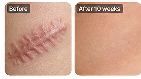 Skin scar comparison