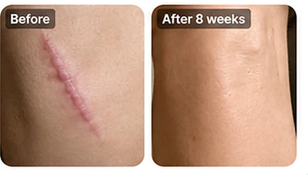 Body scar care