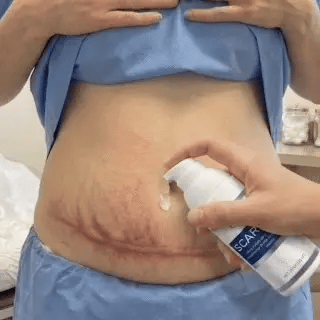 Common scar concerns