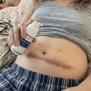 Applying silicone scar gel